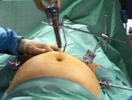 Laparoscopic Bariatric Surgery, London UK