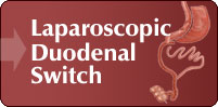 Laparoscopic Duodenal Switch, London UK