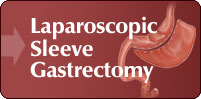 Laparoscopic Sleeve Gastrectomy, London UK